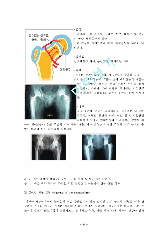 [의학,약학][의학] 고관절 전치술, 슬관절 전치술 -THR [Total Hip Replacement], TKR[Total Knee Replacement]   (6 )